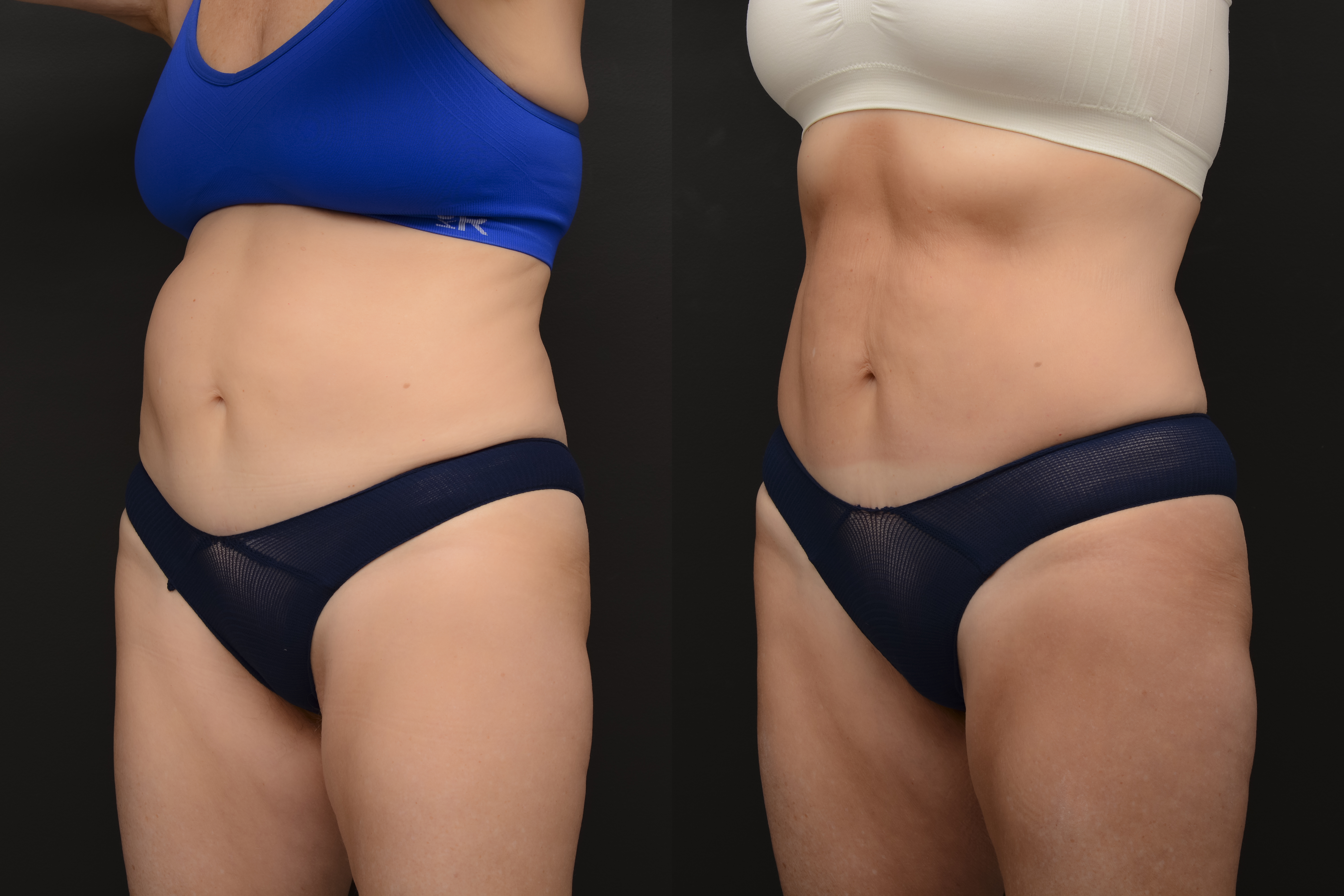 Emsculpt abdomen transformation - before and after